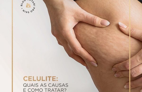 Celulite: Quais as causas e como tratar?